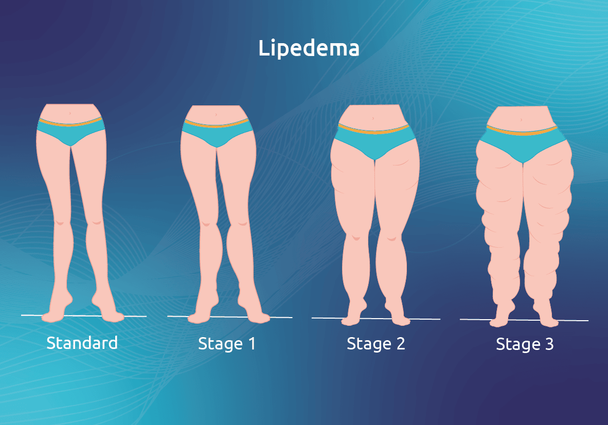 We Now Provide Standardized Lipedema Physical Evaluations! One River
